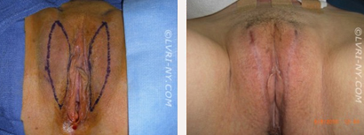Designer Laser Vaginoplasty Before & After New York