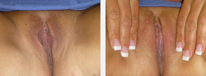 Designer Laser Vaginoplasty® Before & After New York