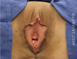 Combo Laser Vaginal Rejuvenation® – Designer Laser Vaginoplasty® – (LVR®-DLV®) Case 2096 Before Photo Combo Laser Vaginal Rejuvenation® – Designer Laser Vaginoplasty® – (LVR®-DLV®)