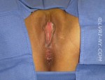 Combo Laser Vaginal Rejuvenation® – Designer Laser Vaginoplasty® with Improvement of Hemorrhoids– (LVR®-DLV®-IH)