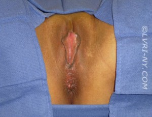 Combo Laser Vaginal Rejuvenation® – Designer Laser Vaginoplasty® with Improvement of Hemorrhoids– (LVR®-DLV®-IH)