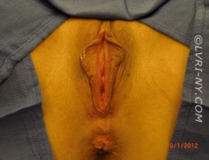 Combo Laser Vaginal Rejuvenation® – Designer Laser Vaginoplasty® with Improvement of Hemorrhoids– (LVR®-DLV®-IH) Case 2168 Before Photo Combo Laser Vaginal Rejuvenation® – Designer Laser Vaginoplasty® with Improvement of Hemorrhoids– (LVR®-DLV®-IH)
