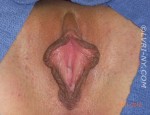 Designer Laser Vaginoplasty® 1 – (DLV®1) Labiaplasty of the Labia Minora with Excision of Excess Prepuce (Also Known as Clitoral Unhooding)