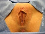 Designer Laser Vaginoplasty® 1 – (DLV®1) Labiaplasty of the Labia Minora with Excision of Excess Prepuce (Also Known as Clitoral Unhooding)