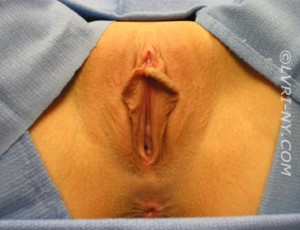 Designer Laser Vaginoplasty® 1 – (DLV®1) Labiaplasty of the Labia Minora with Excision of Excess Prepuce (Also Known as Clitoral Unhooding) Case 2276 Before Photo Designer Laser Vaginoplasty® 1 – (DLV®1) Labiaplasty of the Labia Minora with Excision of Excess Prepuce (Also Known as Clitoral Unhooding)