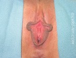 Vampire Wing Lift (Labia Majora Augmentation with Autologous Fat Injection, Filler and/or Platelet Rich Plasma (PRP)