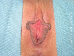 Vampire Wing Lift (Labia Majora Augmentation with Autologous Fat Injection, Filler and/or Platelet Rich Plasma (PRP) Case 2366 Before Photo Vampire Wing Lift (Labia Majora Augmentation with Autologous Fat Injection, Filler and/or Platelet Rich Plasma (PRP)