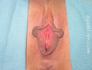 Vampire Wing Lift (Labia Majora Augmentation with Autologous Fat Injection, Filler and/or Platelet Rich Plasma (PRP)