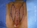 Designer Laser Vaginoplasty 3 (DLV3) - Labia Majora Reduction