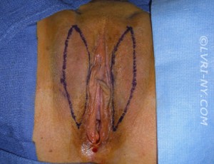 Designer Laser Vaginoplasty 3 (DLV3) - Labia Majora Reduction Case 2372 Before Photo Designer Laser Vaginoplasty 3 (DLV3) - Labia Majora Reduction