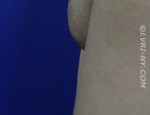 Designer Laser Vaginoplasty 4 (DLV4) – Mons Pubic Lift