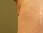 Designer Laser Vaginoplasty 4 (DLV4) – Mons Pubic Lift