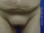 Designer Laser Vaginoplasty 4 (DLV4) – Mons Pubic Lift