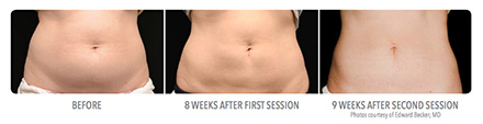 Coolsculpting Before & AFter