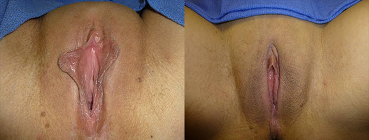 Combination Laser Vaginal Rejuvenation® & Designer Laser Vaginoplasty