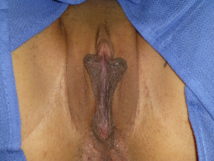 Designer Laser Vaginoplasty® 2 – (DLV®2) Labiaplasty of the Labia Minora without Excision of Excess Prepuce (without Clitoral Unhooding)