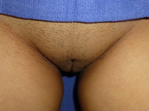 Designer Laser Vaginoplasty® Standing (DLV® –S) Labiaplasty of Labia Minora Standing (with or without Excision of Excess Prepuce) Case 4173 After Photo Designer Laser Vaginoplasty® Standing (DLV® –S) Labiaplasty of Labia Minora Standing (with or without Excision of Excess Prepuce)