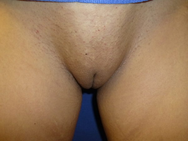 Designer Laser Vaginoplasty® Standing (DLV® –S) Labiaplasty of Labia Minora Standing (with or without Excision of Excess Prepuce)