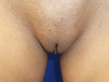 Designer Laser Vaginoplasty® Standing (DLV® –S) Labiaplasty of Labia Minora Standing (with or without Excision of Excess Prepuce)