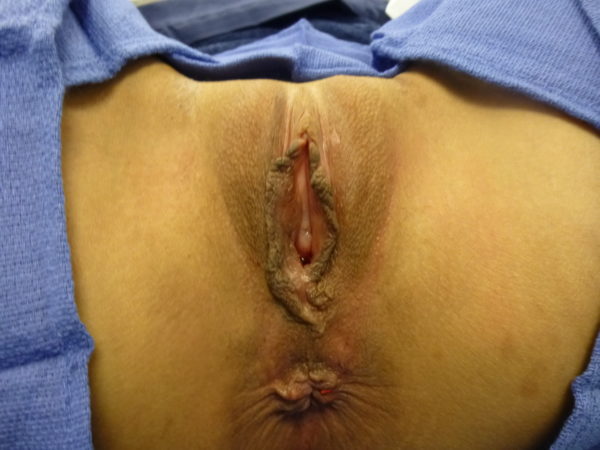 Combo Laser Vaginal Rejuvenation® – Designer Laser Vaginoplasty® with Improvement of Hemorrhoids– (LVR®-DLV®-IH) Case 4118 Before Photo Combo Laser Vaginal Rejuvenation® – Designer Laser Vaginoplasty® with Improvement of Hemorrhoids– (LVR®-DLV®-IH)