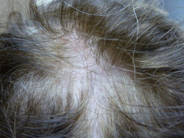 Vampire Hair Regrowth Case 4325 Before Photo Vampire Hair Regrowth