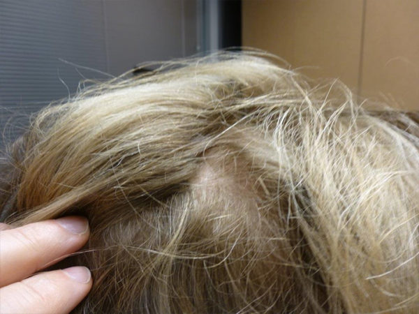 Vampire Hair Regrowth Case 4325 After Photo Vampire Hair Regrowth