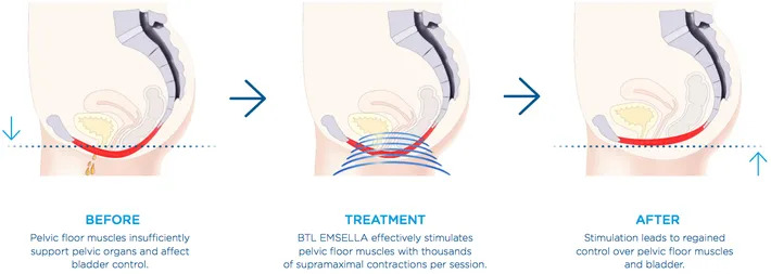 BTL Esmella Procedure