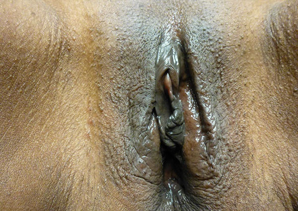 Vampire Wing Lift (Labia Majora Augmentation with Autologous Fat Injection, Filler and/or Platelet Rich Plasma (PRP) Case 4386 Before Photo Vampire Wing Lift (Labia Majora Augmentation with Autologous Fat Injection, Filler and/or Platelet Rich Plasma (PRP)