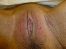 Vampire Wing Lift (Labia Majora Augmentation with Autologous Fat Injection, Filler and/or Platelet Rich Plasma (PRP)